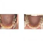 Before and After Treatment with Ceramic Crowns and Bonded Restoration
