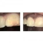 Restoration with Bonded Filling to a Discolored/Decayed Tooth