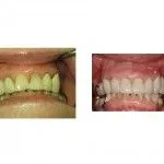 Before and After Restoring with Crowns and Removable Bridge