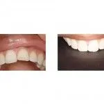 Before and After Restoring Misaligned Tooth with Bonded Restoration