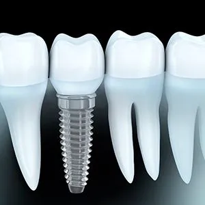 DENTAL IMPLANTS