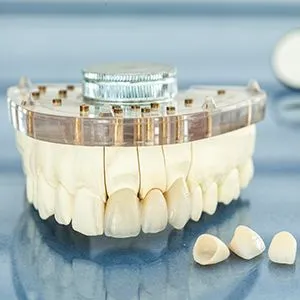 PORCELAIN VENEERS