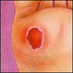 Diabetic Wound Care in Winter Haven, FL