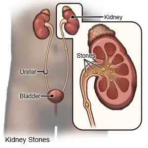 How long does it take to pass a on sale kidney stone