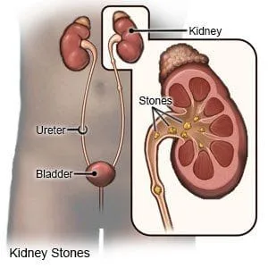 kidney stone