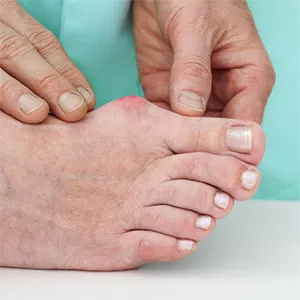 bunion treatment