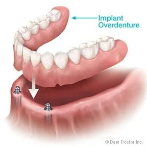Image result for implant supported dentures