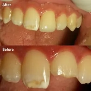 OAI Before and After Smile Gallery Mt. Pleasant IA, ORTHODONTIC ASSOCIATES  of IOWA