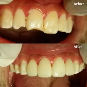 OAI Before and After Smile Gallery Mt. Pleasant IA, ORTHODONTIC ASSOCIATES  of IOWA