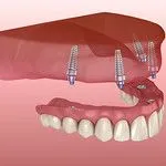 Implant Dentistry