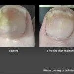 Toenail Fungus Laser Treatment in Oakland, CA