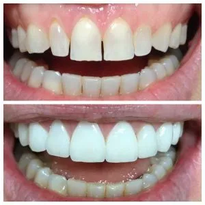 Smile Gallery - Before and After Dental Photos - Smile Makeovers Encinitas,  CA