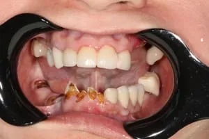 Failing Dentition