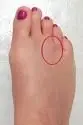 Neuroma