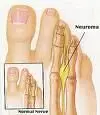 neuroma