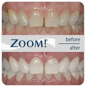 before and after photo zoom teeth whitening Mahwah, NJ