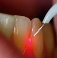 laser root canal plantation fl