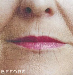 Before -Juvederm