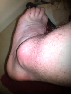 Ankle_acute_1.jpg