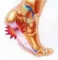 Plantar Fascia