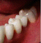 dental implant