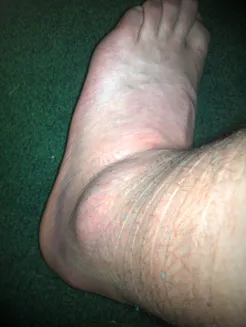 Ankle_48_hours_after_1.jpg