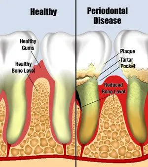 Periodontics Lafayette