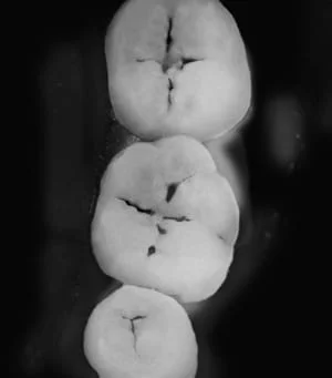 transilluminated-teeth-caries