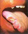 Oral Cancer