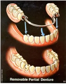 Removable Partial and Complete Dentures Cedar Rapids