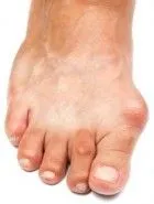 Bunions Treatment | Foot Disorder Treatment | Takoma Park | Riverdale MD | Laurel MD | Rockville MD