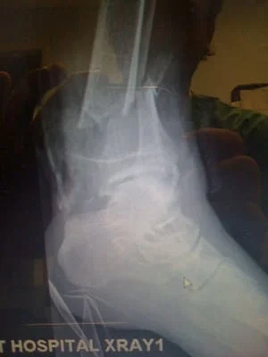fracture_before.JPG