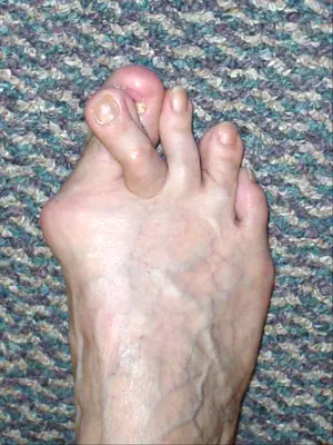 Foot with a Bunion