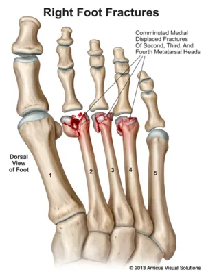 Neck Fractures - Robert Sheinberg, DPM | Weston, FL Podiatrist