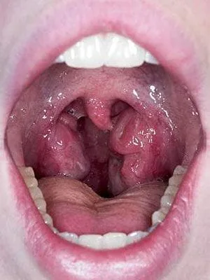 throat