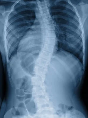x-ray of Scoliosis spine in Hansen Chiropractic in West Babylon