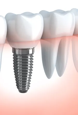 dental implants