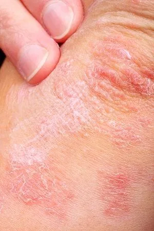 Psoriasis