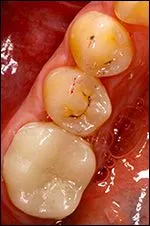 inside of mouth showing back tooth after metal filling removed, replaced with dental crown New Baltimore, MI dentist