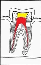 Finished root canal with composite buildup and crown