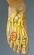 Mortons_Neuroma2.jpg