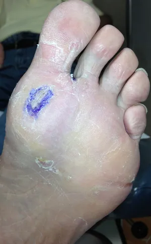 Diabetic Wound Before Dermagraft