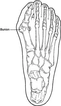 Bunions In Sterling Heights, MI