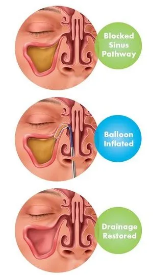 anatomy of sinus infection