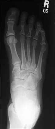 foot_x_ray_top.jpg