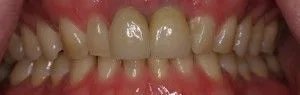 Dental Implants – After