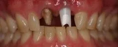 Dental Implants – Before