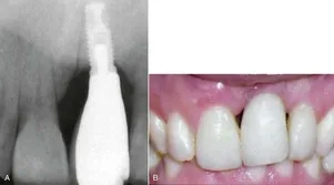 Bone Grafting