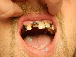 Before Immediate Denture