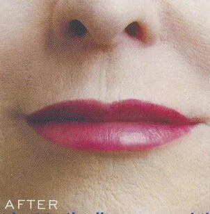 After- Juvederm